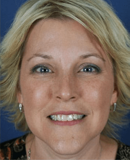 Gummy Smile after treatment