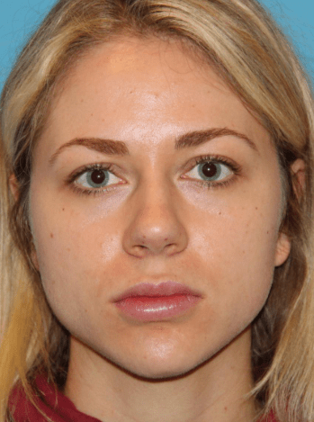 Slimmer jawline before treatment